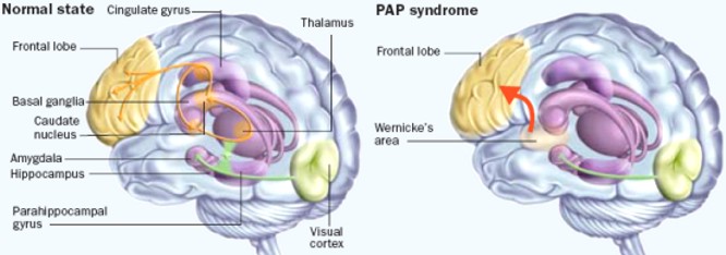 Brain in case of PAP syndrome