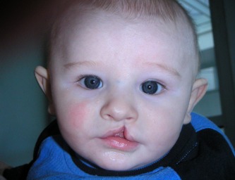 Child with harelip/ Innated