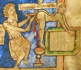 Hemorojaus gydymas Viduramiais