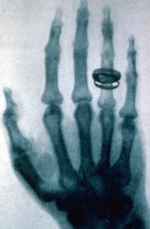 Roentgen X-ray picture of the hand of his wife, taken 23 January 1896
